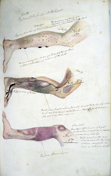 Illustration for article titled This is why scurvy is one of evolution's greatest mysteries